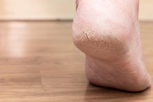 Tak cukup lotion biasa, ini cara cepat kurangi pecah-pecah pada tumit kering pakai 1 jenis minyak