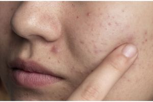 Tanpa ditambah bubuk kopi, ini trik bersihkan pori-pori wajah pakai masker dari 1 jenis tepung