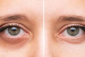 Tanpa kunyit dan minyak zaitun, ini trik atasi mata bengkak dan sembap cuma pakai 1 jenis buah