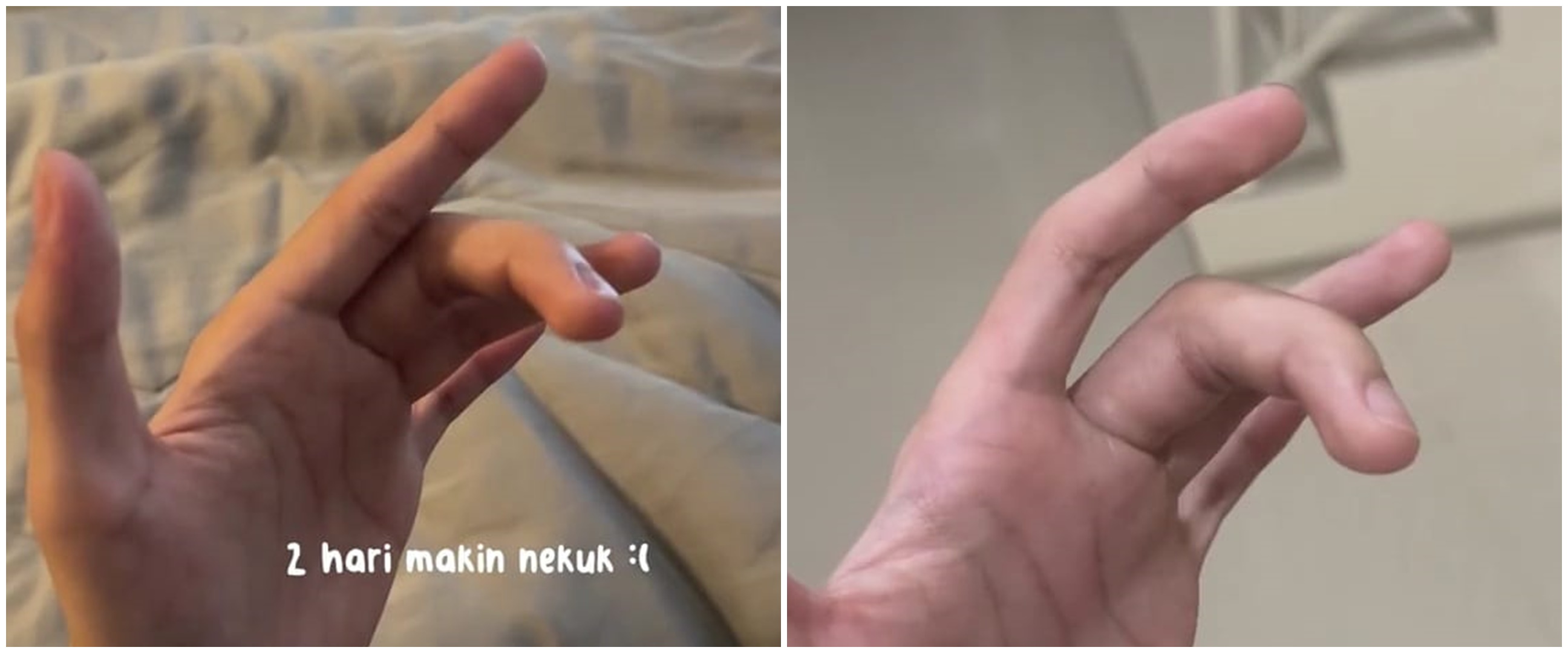 Curhat netizen sendi jari sakit dikira terkilir ternyata autoimun, ceritanya bikin pilu