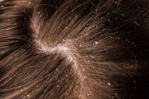 Tanpa tambahan tea tree oil, ini trik hilangkan ketombe berkerak pakai hair spray dari 1 jenis buah