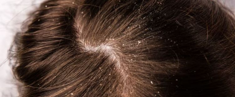 Tanpa tambahan tea tree oil, ini trik hilangkan ketombe berkerak pakai hair spray dari 1 jenis buah