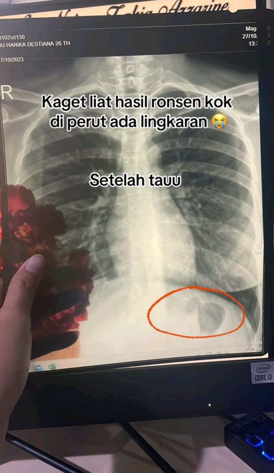 Kaget lihat bentuk aneh di hasil rontgen perutnya, wanita ini malu setelah tahu jawaban dokter