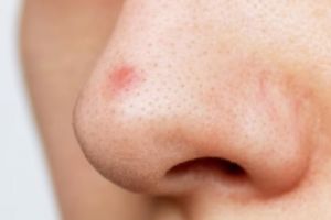 Nggak perlu facial, ini trik bersihkan pori tersumbat penyebab komedo cuma pakai 1 bahan kue