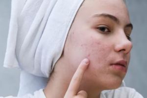 11 Rekomendasi skincare jerawat untuk remaja merek lokal di bawah Rp 150 ribu, wajah mulus antiiritasi