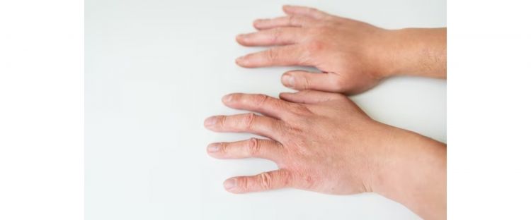Gunakan Beras Dan Susu Untuk Mencerahkan Tangan Anda Dengan Mudah