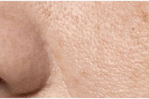 Tanpa produk eksfoliasi, ini trik kecilkan pori-pori di hidung dan dagu pakai 1 bahan rempah