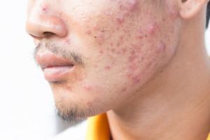 Tak hanya kunyit, ini trik bikin wajah bebas komedo dan jerawat pakai 1 produk fermentasi