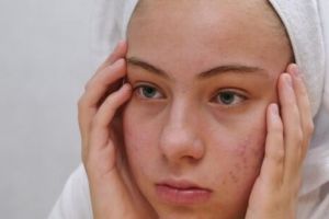 11 Skincare penghilang jerawat meradang merek lokal di bawah Rp 150 ribu, wajah mulus antibopeng