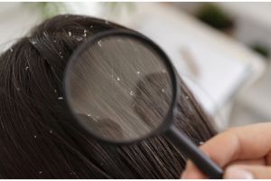 Tak perlu gunakan jeruk nipis, ini trik bersihkan kulit kepala dari ketombe pakai 1 jenis daun