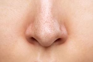 Wajah halus bebas komedo, ini cara atasi pori tersumbat di area hidung pakai scrub dari 1 jenis tepung