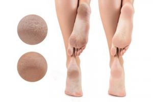 Bukan gunakan tawas, ini trik haluskan tumit kaki kering dan pecah pakai 2 bahan pemanis