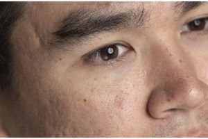 Tanpa gunakan es batu, ini cara mudah kecilkan pori-pori agar wajah bebas jerawat pakai 1 bubuk daun