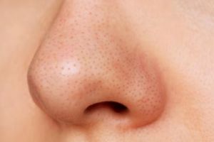 Nggak perlu facial mahal, ini cara hempas komedo dan pori besar di wajah pakai 1 jenis tanaman herbal