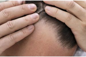 Tanpa pakai hair tonic, ini cara ampuh atasi rambut tipis depan gunakan hair oil dari 1 macam bunga