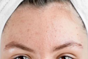 11 Skincare untuk bruntusan di jidat merek lokal di bawah Rp 150 ribu, wajah mulus tak bertekstur
