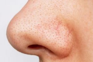 Nggak cuma pakai lemon, ini cara bersihkan komedo hitam di area hidung dengan tambahan 2 jenis pemanis