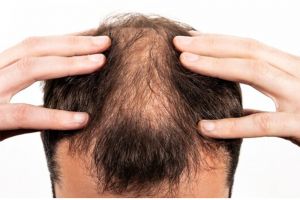 Tanpa ditambah daun kari, ini cara atasi rambut pitak tengah pakai hair oil dari 1 jenis tanaman