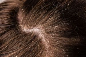 Tanpa lemon dan minyak kelapa, ini cara hempas ketombe basah dan kering pakai 1 jenis daun