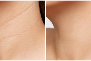 Tanpa gunakan madu dan oatmeal, ini cara merontokkan daki hitam di leher pakai 1 jenis tanaman