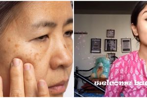 Tampak dalam 7 hari, ini cara hilangkan flek hitam di wajah bikin kulit auto cerah pakai 1 jenis umbi