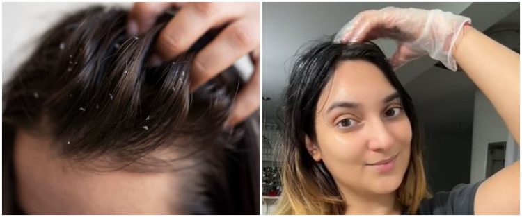 Tanpa sampo khusus, ini cara atasi ketombe dan kulit kepala mengelupas cuma pakai 2 bahan dapur