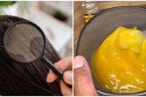 Rambut bersih tanpa lemon, ini cara atasi ketombe akibat kulit kepala mengelupas pakai 1 bahan dapur