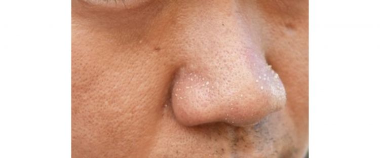 Bukan daun kemangi, ini trik bikin pori-pori besar jadi rapat tak berkomedo pakai 1 jenis buah