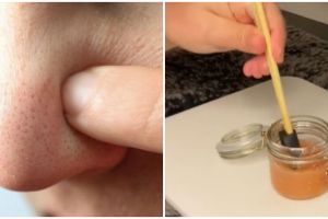 Bukan pakai kunyit, ini trik membuka pori-pori tersumbat untuk atasi komedo dengan 2 jenis buah