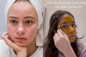 Mulus tanpa air beras, ini trik bikin pori-pori bersih dari kotoran penyebab jerawat pakai 1 minuman