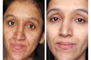 Tanpa serum dark spot, wanita ini pudarkan noda hitam di wajah cuma pakai 1 air bekas bahan makanan