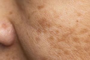 Nggak perlu tambahan kunyit, ini trik hilangkan flek hitam di area pipi pakai 1 jenis umbi-umbian