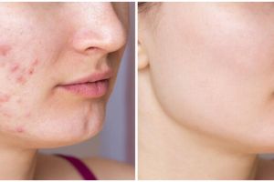 11 Produk skincare untuk menghilangkan bekas jerawat dan mengecilkan pori-pori di bawah Rp 200 ribu