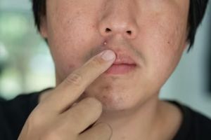 11 Rekomendasi skincare Korea untuk kulit berjerawat di bawah Rp 300 ribu, auto sehat dan glowing