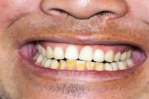 Bukan pakai lemon dan garam, ini trik memutihkan gigi kuning dan atasi bau mulut pakai 1 jenis minyak