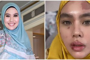 Kulit wajah dan bibir melepuh, begini penjelasan Kartika Putri soal penyebab penyakit yang dialaminya