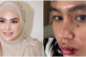 Idap autoimun hingga kulitnya melepuh, begini kondisi terkini Kartika Putri usai berobat ke Singapura