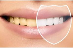 Tanpa scalling di dokter, ini trik hilangkan plak di gigi hanya pakai 3 bahan alami