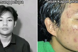 Cerita karyawan nggak diizinin tangani pelanggan karena wajah berjerawat ini nyesek banget