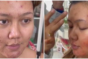 Transformasi makeup wanita wajah breakout kemerahan ini hasilnya auto mulus, flawless antidempul