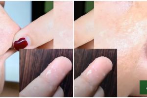 Tak perlu pencet-pencet sampai sakit, wanita ini bagikan cara ampuh usir komedo andalkan 1 bahan dapur