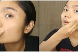 Tanpa serum acne, cara atasi jerawat meradang rekomendasi dokter ini cuma butuh 1 bahan alami