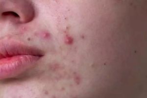 Tanpa serum acne, 13 cara mengatasi jerawat meradang pakai bahan alami ini bikin wajah antikemerahan