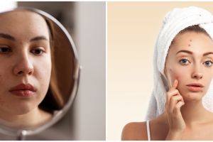 Tanpa perasan jeruk, beauty vlogger ini tunjukkan trik hilangkan bekas jerawat pakai 1 jenis sayuran