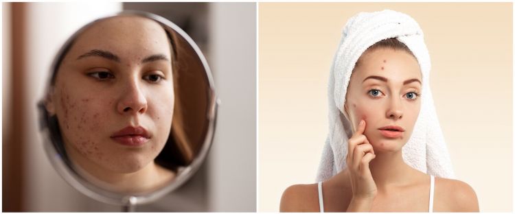 Trik Beuty Hacks VIRAL 2025: Hilangkan Jerawat dengan Cara Alami