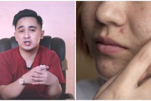 Tanpa gunakan lemon, ini cara menghilangkan jerawat di wajah ala rekomendasi dokter pakai 1 jenis buah