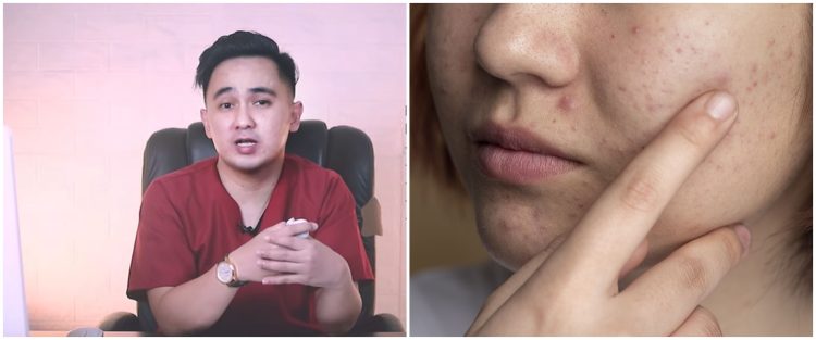 Tanpa gunakan lemon, ini cara menghilangkan jerawat di wajah ala