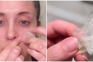 Nggak perlu beli pore pack, 13 cara menghilangkan komedo pakai bahan alami ini bikin wajah auto mulus
