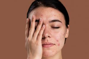 10 Rekomendasi skincare Whitelab untuk atasi jerawat harga di bawah Rp 100 ribu, wajah auto mulus