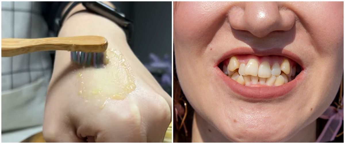 Putih dalam satu menit, ini cara atasi gigi kuning pakai baking soda